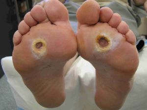 How To Prevent The Onset Of Diabetic Foot Ulcers